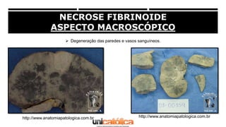 NECROSE FIBRINOIDE
ASPECTO MACROSCÓPICO
 Degeneração das paredes e vasos sanguíneos.
http://www.anatomiapatologica.com.br...