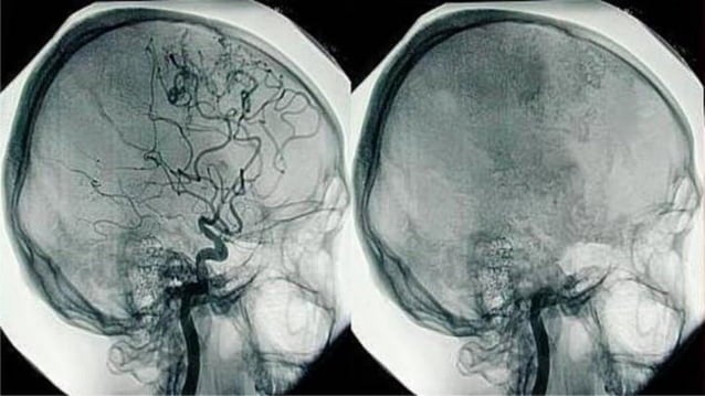 MORTE ENCEFÁLICA de pacientes........pdf