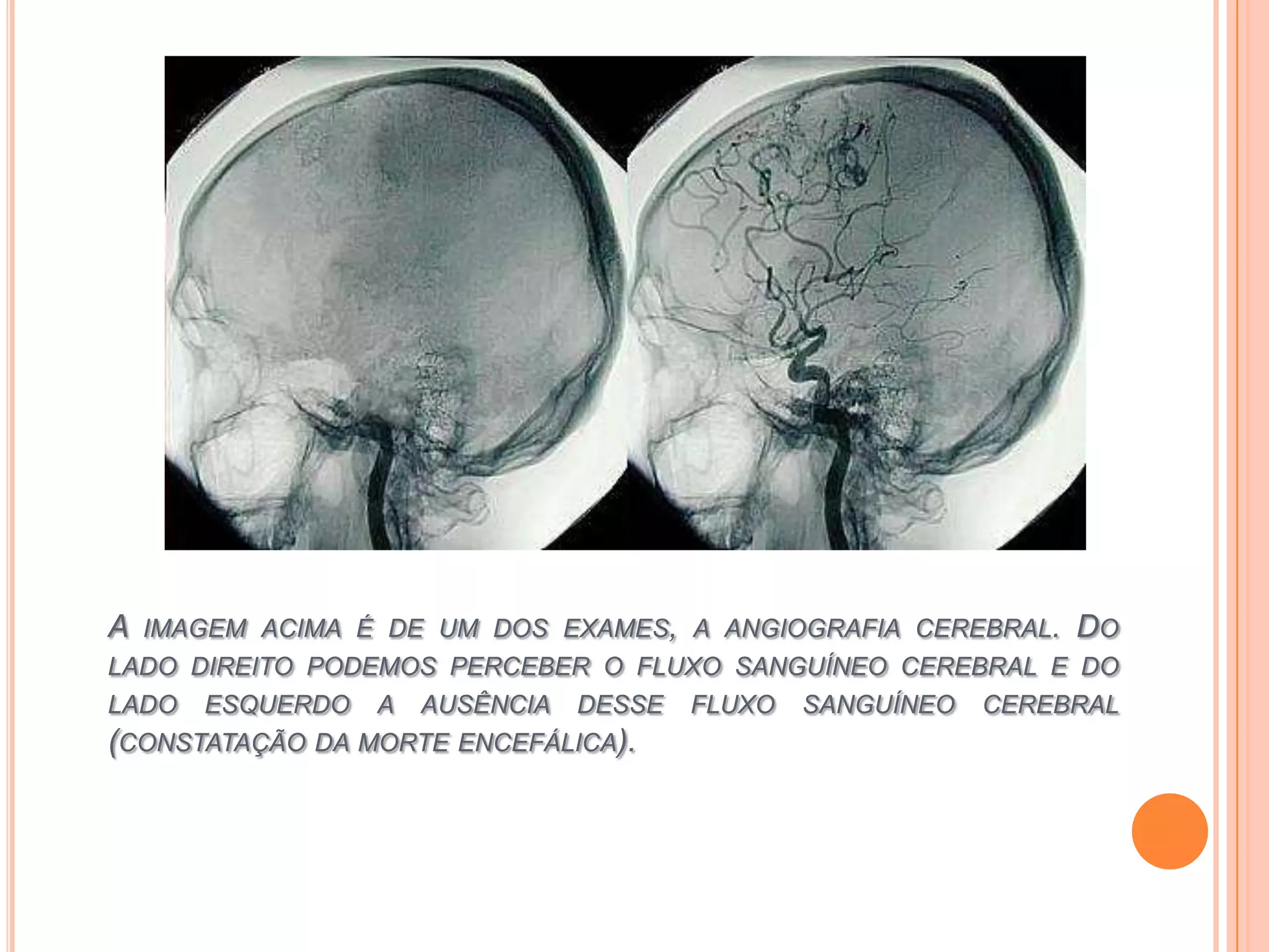 Morte encefálica enfermagem farec | PPTX