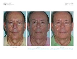 before                  after                                       after
         (Using ageLoC transformation for 60 days)   (Using ageLoC transformation for 90 days)
 
