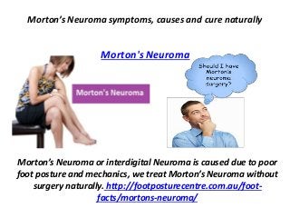 Morton’s Neuroma symptoms, causes and cure naturally
Morton's Neuroma
Morton’s Neuroma or interdigital Neuroma is caused due to poor
foot posture and mechanics, we treat Morton’s Neuroma without
surgery naturally. http://footposturecentre.com.au/foot-
facts/mortons-neuroma/
 