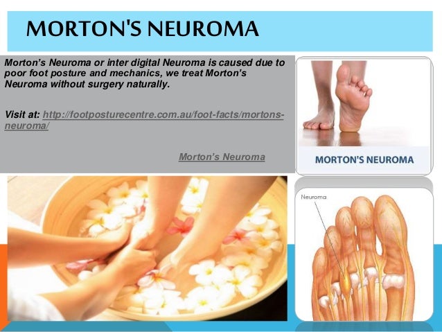 How is Morton's neuroma treated?