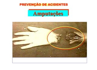 Amputações
PREVENÇÃO DE ACIDENTES
 