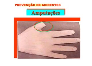 Amputações
PREVENÇÃO DE ACIDENTES
 