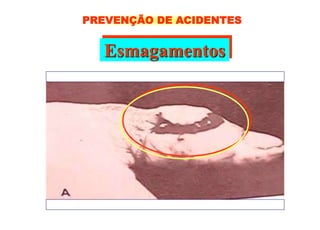 Esmagamentos
PREVENÇÃO DE ACIDENTES
 