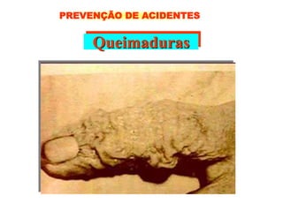 Queimaduras
PREVENÇÃO DE ACIDENTES
 