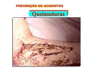 Queimaduras
PREVENÇÃO DE ACIDENTES
 