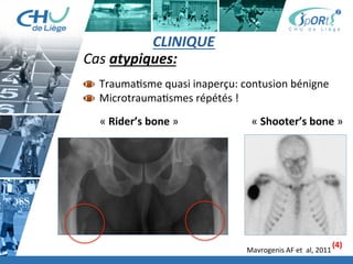 Titre	
  de	
  la	
  page	
  1	
  
Lorem	
  ipsum	
  dolor	
  sit	
  amet,	
  consectetur	
  adipiscing	
  elit,	
  sed	
  do	
  eiusmod	
  tempor	
  incididunt	
  ut	
  
labore	
  et	
  dolore	
  magna	
  aliqua.	
  Ut	
  enim	
  ad	
  minim	
  veniam,	
  quis	
  nostrud	
  exercita:on	
  ullamco	
  laboris	
  
nisi	
  ut	
  aliquip	
  ex	
  ea	
  commodo	
  consequat.	
  Duis	
  aute	
  irure	
  dolor	
  in	
  reprehenderit	
  in	
  voluptate	
  velit	
  esse	
  
cillum	
  dolore	
  eu	
  fugiat	
  nulla	
  pariatur.	
  Excepteur	
  sint	
  occaecat	
  cupidatat	
  non	
  proident,	
  sunt	
  in	
  culpa	
  qui	
  
oﬃcia	
  deserunt	
  mollit	
  anim	
  id	
  est	
  laborum.	
  »	
  
	
  
Lorem	
  ipsum	
  dolor	
  sit	
  amet,	
  consectetur	
  adipiscing	
  elit,	
  sed	
  do	
  eiusmod	
  tempor	
  incididunt	
  ut	
  labore	
  et	
  
dolore	
  magna	
  aliqua.	
  Ut	
  enim	
  ad	
  minim	
  veniam,	
  quis	
  nostrud	
  exercita:on	
  ullamco	
  laboris	
  nisi	
  ut	
  
aliquip	
  ex	
  ea	
  commodo	
  consequat.	
  Duis	
  aute	
  irure	
  dolor	
  in	
  reprehenderit	
  in	
  voluptate	
  velit	
  esse	
  cillum	
  
dolore	
  eu	
  fugiat	
  nulla	
  pariatur.	
  Excepteur	
  sint	
  occaecat	
  cupidatat	
  non	
  proident,	
  sunt	
  in	
  culpa	
  qui	
  oﬃcia	
  
deserunt	
  mollit	
  anim	
  id	
  est	
  laborum.	
  »	
  
	
  
Lorem	
  ipsum	
  dolor	
  sit	
  amet,	
  consectetur	
  adipiscing	
  elit,	
  sed	
  do	
  eiusmod	
  tempor	
  incididunt	
  ut	
  labore	
  et	
  
dolore	
  magna	
  aliqua.	
  Ut	
  enim	
  ad	
  minim	
  veniam,	
  quis	
  nostrud	
  exercita:on	
  ullamco	
  laboris	
  nisi	
  ut	
  
aliquip	
  ex	
  ea	
  commodo	
  consequat.	
  Duis	
  aute	
  irure	
  dolor	
  in	
  reprehenderit	
  in	
  voluptate	
  velit	
  esse	
  cillum	
  
dolore	
  eu	
  fugiat	
  nulla	
  pariatur.	
  Excepteur	
  sint	
  occaecat	
  cupidatat	
  non	
  proident,	
  sunt	
  in	
  culpa	
  qui	
  oﬃcia	
  
deserunt	
  mollit	
  anim	
  id	
  est	
  laborum."	
  
CLINIQUE	
  
Cas	
  atypiques:	
  
 	
  Trauma:sme	
  quasi	
  inaperçu:	
  contusion	
  bénigne	
  
 	
  Microtrauma:smes	
  répétés	
  !	
  
«	
  Shooter’s	
  bone	
  »	
  «	
  Rider’s	
  bone	
  »	
  
Mavrogenis	
  AF	
  et	
  	
  al,	
  2011	
  
(4)	
  
 