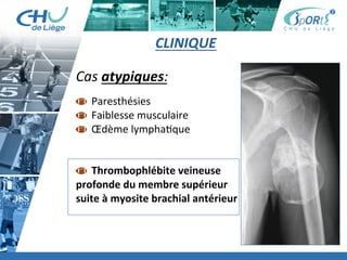 Titre	
  de	
  la	
  page	
  1	
  
Lorem	
  ipsum	
  dolor	
  sit	
  amet,	
  consectetur	
  adipiscing	
  elit,	
  sed	
  do	
  eiusmod	
  tempor	
  incididunt	
  ut	
  
labore	
  et	
  dolore	
  magna	
  aliqua.	
  Ut	
  enim	
  ad	
  minim	
  veniam,	
  quis	
  nostrud	
  exercita:on	
  ullamco	
  laboris	
  
nisi	
  ut	
  aliquip	
  ex	
  ea	
  commodo	
  consequat.	
  Duis	
  aute	
  irure	
  dolor	
  in	
  reprehenderit	
  in	
  voluptate	
  velit	
  esse	
  
cillum	
  dolore	
  eu	
  fugiat	
  nulla	
  pariatur.	
  Excepteur	
  sint	
  occaecat	
  cupidatat	
  non	
  proident,	
  sunt	
  in	
  culpa	
  qui	
  
oﬃcia	
  deserunt	
  mollit	
  anim	
  id	
  est	
  laborum.	
  »	
  
	
  
Lorem	
  ipsum	
  dolor	
  sit	
  amet,	
  consectetur	
  adipiscing	
  elit,	
  sed	
  do	
  eiusmod	
  tempor	
  incididunt	
  ut	
  labore	
  et	
  
dolore	
  magna	
  aliqua.	
  Ut	
  enim	
  ad	
  minim	
  veniam,	
  quis	
  nostrud	
  exercita:on	
  ullamco	
  laboris	
  nisi	
  ut	
  
aliquip	
  ex	
  ea	
  commodo	
  consequat.	
  Duis	
  aute	
  irure	
  dolor	
  in	
  reprehenderit	
  in	
  voluptate	
  velit	
  esse	
  cillum	
  
dolore	
  eu	
  fugiat	
  nulla	
  pariatur.	
  Excepteur	
  sint	
  occaecat	
  cupidatat	
  non	
  proident,	
  sunt	
  in	
  culpa	
  qui	
  oﬃcia	
  
deserunt	
  mollit	
  anim	
  id	
  est	
  laborum.	
  »	
  
	
  
Lorem	
  ipsum	
  dolor	
  sit	
  amet,	
  consectetur	
  adipiscing	
  elit,	
  sed	
  do	
  eiusmod	
  tempor	
  incididunt	
  ut	
  labore	
  et	
  
dolore	
  magna	
  aliqua.	
  Ut	
  enim	
  ad	
  minim	
  veniam,	
  quis	
  nostrud	
  exercita:on	
  ullamco	
  laboris	
  nisi	
  ut	
  
aliquip	
  ex	
  ea	
  commodo	
  consequat.	
  Duis	
  aute	
  irure	
  dolor	
  in	
  reprehenderit	
  in	
  voluptate	
  velit	
  esse	
  cillum	
  
dolore	
  eu	
  fugiat	
  nulla	
  pariatur.	
  Excepteur	
  sint	
  occaecat	
  cupidatat	
  non	
  proident,	
  sunt	
  in	
  culpa	
  qui	
  oﬃcia	
  
deserunt	
  mollit	
  anim	
  id	
  est	
  laborum."	
  
CLINIQUE	
  
Cas	
  atypiques:	
  
	
  
 	
  Paresthésies	
  
 	
  Faiblesse	
  musculaire	
  
 	
  Œdème	
  lympha:que	
  
	
  
	
  
 	
  Thrombophlébite	
  veineuse	
  	
  
profonde	
  du	
  membre	
  supérieur	
  	
  
suite	
  à	
  myosite	
  brachial	
  antérieur	
  
 