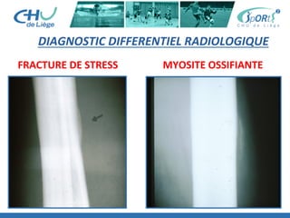 DIAGNOSTIC	
  DIFFERENTIEL	
  RADIOLOGIQUE	
  
FRACTURE	
  DE	
  STRESS	
   MYOSITE	
  OSSIFIANTE	
  
 