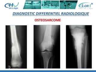 DIAGNOSTIC	
  DIFFERENTIEL	
  RADIOLOGIQUE	
  
OSTEOSARCOME	
  
 
