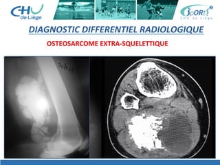 DIAGNOSTIC	
  DIFFERENTIEL	
  RADIOLOGIQUE	
  
OSTEOSARCOME	
  EXTRA-­‐SQUELETTIQUE	
  
 
