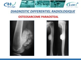 DIAGNOSTIC	
  DIFFERENTIEL	
  RADIOLOGIQUE	
  
OSTEOSARCOME	
  PARAOSTEAL	
  
 