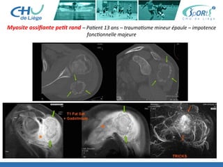 Myosite	
  ossiﬁante	
  peXt	
  rond	
  –	
  Pa'ent	
  13	
  ans	
  –	
  trauma'sme	
  mineur	
  épaule	
  –	
  impotence	
  
fonc'onnelle	
  majeure	
  
 