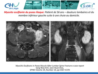 Myosite	
  ossiﬁante	
  du	
  psoas	
  iliaque:	
  Pa'ent	
  de	
  56	
  ans	
  –	
  douleurs	
  lombaires	
  et	
  du	
  
membre	
  inférieur	
  gauche	
  suite	
  à	
  une	
  chute	
  au	
  domicile.	
  
Myosi's	
  Ossiﬁcans	
  in	
  Psoas	
  Muscle	
  AOer	
  Lumbar	
  Spine	
  Fracture	
  a	
  case	
  report	
  
Sang	
  Woo	
  Kim,	
  Joon	
  Hyuk	
  Choi,	
  	
  
SPINE	
  Volume	
  34,	
  Number	
  10,	
  pp	
  E367–E370	
  
 