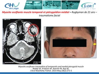 Myosite	
  ossiﬁante	
  muscle	
  temporal	
  et	
  ptérygoïdien	
  médial	
  –	
  Rugbyman	
  de	
  21	
  ans	
  –	
  
trauma'sme	
  facial	
  	
  	
  
Myosi's	
  ossiﬁcans	
  trauma'ca	
  of	
  temporalis	
  and	
  medial	
  pterygoid	
  muscle	
  
Reddy	
  SP,	
  Prakash	
  AP,	
  Keerthi	
  M,	
  Rao	
  BJ.	
  
J	
  Oral	
  Maxillofac	
  Pathol.	
  2014	
  May;18(2):271-­‐5	
  
 
