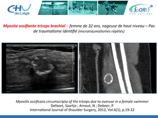 Myosite	
  ossiﬁante	
  triceps	
  brachial	
  –	
  femme	
  de	
  32	
  ans,	
  nageuse	
  de	
  haut	
  niveau	
  –	
  Pas	
  
de	
  trauma'sme	
  iden'ﬁé	
  (microtrauma'smes	
  répétés)	
  
Myosi's	
  ossiﬁcans	
  circumscripta	
  of	
  the	
  triceps	
  due	
  to	
  overuse	
  in	
  a	
  female	
  swimmer	
  
Defoort,	
  Saartje	
  ;	
  Arnout,	
  N	
  ;	
  Debeer,	
  P	
  
Interna:onal	
  Journal	
  of	
  Shoulder	
  Surgery,	
  2012,	
  Vol.6(1),	
  p.19-­‐22	
  	
  
	
  
 