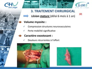 Titre	
  de	
  la	
  page	
  1	
  
Lorem	
  ipsum	
  dolor	
  sit	
  amet,	
  consectetur	
  adipiscing	
  elit,	
  sed	
  do	
  eiusmod	
  tempor	
  incididunt	
  ut	
  
labore	
  et	
  dolore	
  magna	
  aliqua.	
  Ut	
  enim	
  ad	
  minim	
  veniam,	
  quis	
  nostrud	
  exercita:on	
  ullamco	
  laboris	
  
nisi	
  ut	
  aliquip	
  ex	
  ea	
  commodo	
  consequat.	
  Duis	
  aute	
  irure	
  dolor	
  in	
  reprehenderit	
  in	
  voluptate	
  velit	
  esse	
  
cillum	
  dolore	
  eu	
  fugiat	
  nulla	
  pariatur.	
  Excepteur	
  sint	
  occaecat	
  cupidatat	
  non	
  proident,	
  sunt	
  in	
  culpa	
  qui	
  
oﬃcia	
  deserunt	
  mollit	
  anim	
  id	
  est	
  laborum.	
  »	
  
	
  
Lorem	
  ipsum	
  dolor	
  sit	
  amet,	
  consectetur	
  adipiscing	
  elit,	
  sed	
  do	
  eiusmod	
  tempor	
  incididunt	
  ut	
  labore	
  et	
  
dolore	
  magna	
  aliqua.	
  Ut	
  enim	
  ad	
  minim	
  veniam,	
  quis	
  nostrud	
  exercita:on	
  ullamco	
  laboris	
  nisi	
  ut	
  
aliquip	
  ex	
  ea	
  commodo	
  consequat.	
  Duis	
  aute	
  irure	
  dolor	
  in	
  reprehenderit	
  in	
  voluptate	
  velit	
  esse	
  cillum	
  
dolore	
  eu	
  fugiat	
  nulla	
  pariatur.	
  Excepteur	
  sint	
  occaecat	
  cupidatat	
  non	
  proident,	
  sunt	
  in	
  culpa	
  qui	
  oﬃcia	
  
deserunt	
  mollit	
  anim	
  id	
  est	
  laborum.	
  »	
  
	
  
Lorem	
  ipsum	
  dolor	
  sit	
  amet,	
  consectetur	
  adipiscing	
  elit,	
  sed	
  do	
  eiusmod	
  tempor	
  incididunt	
  ut	
  labore	
  et	
  
dolore	
  magna	
  aliqua.	
  Ut	
  enim	
  ad	
  minim	
  veniam,	
  quis	
  nostrud	
  exercita:on	
  ullamco	
  laboris	
  nisi	
  ut	
  
aliquip	
  ex	
  ea	
  commodo	
  consequat.	
  Duis	
  aute	
  irure	
  dolor	
  in	
  reprehenderit	
  in	
  voluptate	
  velit	
  esse	
  cillum	
  
dolore	
  eu	
  fugiat	
  nulla	
  pariatur.	
  Excepteur	
  sint	
  occaecat	
  cupidatat	
  non	
  proident,	
  sunt	
  in	
  culpa	
  qui	
  oﬃcia	
  
deserunt	
  mollit	
  anim	
  id	
  est	
  laborum."	
  
  	
  Volume	
  myosite	
  :	
  
ü  Compression	
  structures	
  neurovasculaires	
  
ü  Perte	
  mobilité	
  signiﬁca:ve	
  
 	
  	
  	
  Caractère	
  exostosant	
  :	
  
ü  Douleurs	
  récurrentes	
  à	
  l’eﬀort	
  	
  
Lésion	
  mature	
  (délai	
  6	
  mois	
  à	
  1	
  an)	
  	
  
3.	
  TRAITEMENT	
  CHIRURGICAL	
  	
  
(2)	
  
 