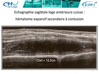 9	
  
Echographie	
  sagiaale	
  loge	
  antérieure	
  cuisse	
  :	
  	
  
hématome	
  expansif	
  secondaire	
  à	
  contusion	
  
 
