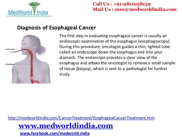 Best Treatment For Esophageal Cancer upthestairsdesigns