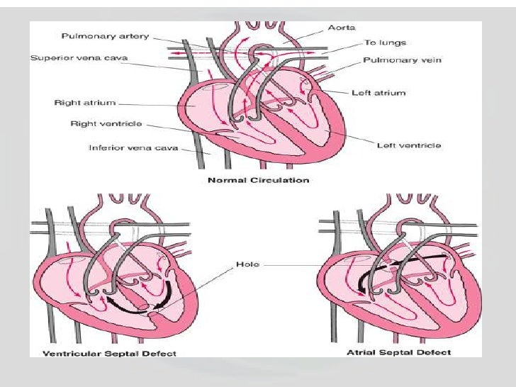 Most affordable heart hole surgery inindia
