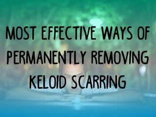 Most Effective Ways of
Permanently Removing
Keloid Scarring
 