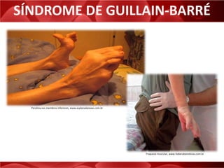 SÍNDROME DE GUILLAIN-BARRÉ
Paralisia nos membros inferiores, www.esplanadanews.com.br
Fraqueza muscular, www.itaberabanoticias.com.br
 