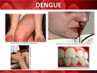 DENGUE
Manchas vermelhas, caminhandosaude.blogspot.com.br
Sangramento no nariz, dengue hemorrágica, www.novidadediaria.com.br
Sangramento gengival, dengue hemorrágica, www.luposeli.com.br
Dornasarticulações,saude.hsw.uol.com.br
 