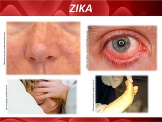 ZIKA
Manchasnorosto,www.tuasaude.com
Olhosvermelhos,www.lookfordiagnosis.com
Dordecabeça,pekdek.com.br
Doresnasarticulações,pelight.com.br
 