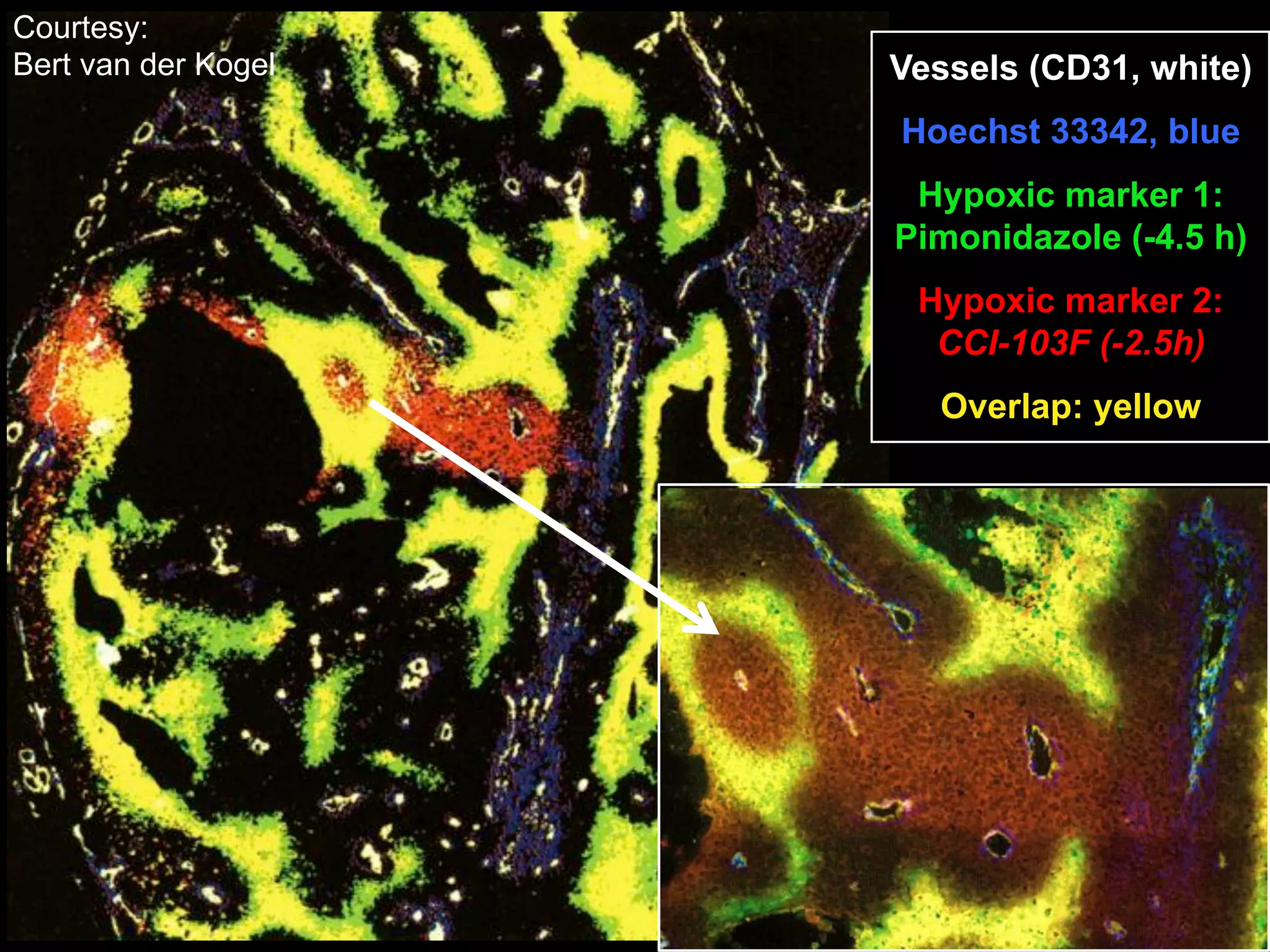 Courtesy:
Bert van der Kogel

Vessels (CD31, white)
Hoechst 33342, blue
Hypoxic marker 1:
Pimonidazole (-4.5 h)
Hypoxic marker 2:
CCI-103F (-2.5h)
Overlap: yellow

 