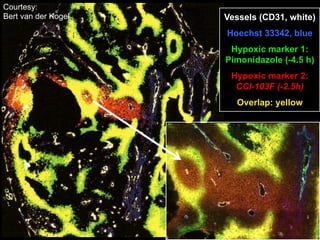 Courtesy:
Bert van der Kogel

Vessels (CD31, white)
Hoechst 33342, blue
Hypoxic marker 1:
Pimonidazole (-4.5 h)
Hypoxic marker 2:
CCI-103F (-2.5h)
Overlap: yellow

 
