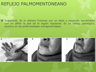 REFLEJO PALMOMENTONEANO
 Superficial. Se lo obtiene frotando con un dedo o raspando ligeramente
con un alfiler la piel de la región hipotenar. Es un reflejo patológico,
positivo en las enfermedades extrapiramidales.
 
