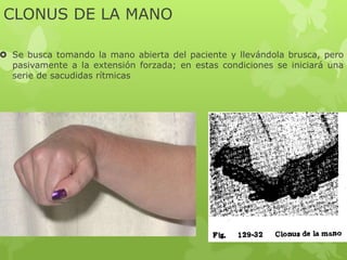CLONUS DE LA MANO
 Se busca tomando la mano abierta del paciente y llevándola brusca, pero
pasivamente a la extensión forzada; en estas condiciones se iniciará una
serie de sacudidas rítmicas
 
