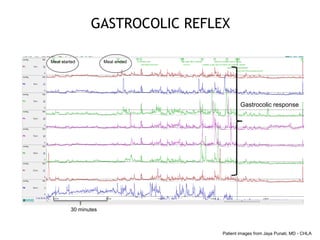 Meal started Meal ended
Gastrocolic response
GASTROCOLIC REFLEX
30 minutes
Patient images from Jaya Punati, MD - CHLA
 
