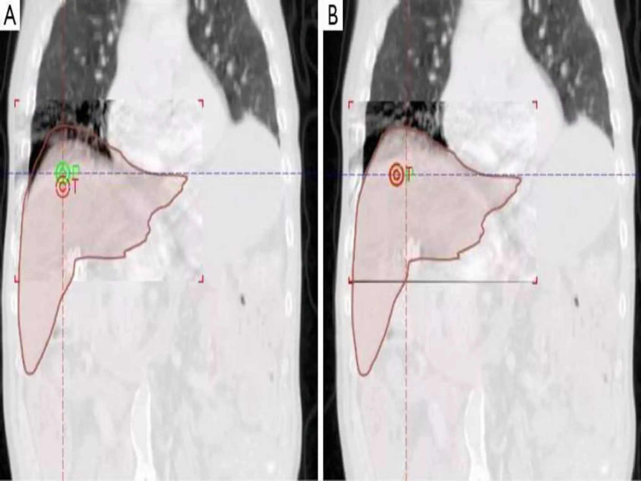 MOTION MANAGEMENT IN RADIOTHERAPY | PPTX