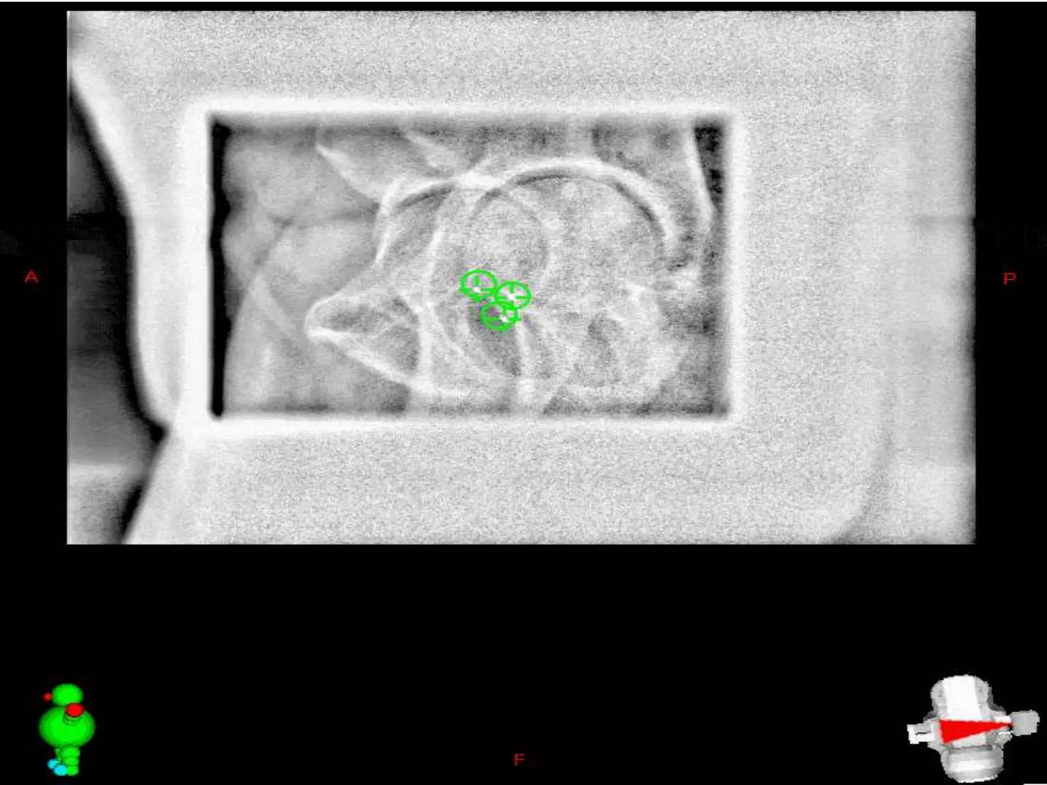MOTION MANAGEMENT IN RADIOTHERAPY | PPTX