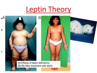 Leptin Theory
• 1970s study-hormone
removal
• Leptin is a hormone that
targets the hypothalamus to
regulate food intake and body
weight.
• Obesity is no longer thought
to be the result of a lack of
will power, but rather a
hormonal imbalance.
(A) Effects of leptin deficiency
(B) (B) After treatment with leptin
 