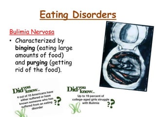 Eating Disorders
Bulimia Nervosa
• Characterized by
binging (eating large
amounts of food)
and purging (getting
rid of the food).
 