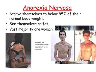 Anorexia Nervosa
• Starve themselves to below 85% of their
normal body weight.
• See themselves as fat.
• Vast majority are woman.
Click on the
woman to watch a
case study of an
anorexic.
 