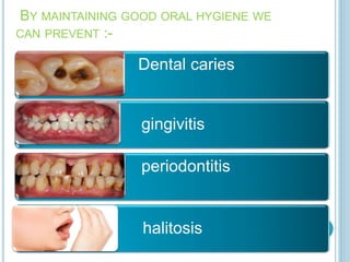 BY MAINTAINING GOOD ORAL HYGIENE WE
CAN PREVENT :-
Dental caries
gingivitis
periodontitis
halitosis
 