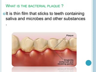 WHAT IS THE BACTERIAL PLAQUE ?
It is thin film that sticks to teeth containing
saliva and microbes and other substances
.
 