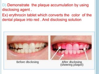 D) Demonstrate the plaque accumulation by using
disclosing agent .
Ex) erythrocin tablet which converts the color of the
dental plaque into red . And disclosing solution
 