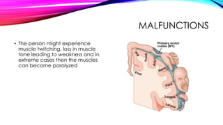 MALFUNCTIONS
• The person might experience
muscle twitching, loss in muscle
tone leading to weakness and in
extreme cases then the muscles
can become paralyzed
 