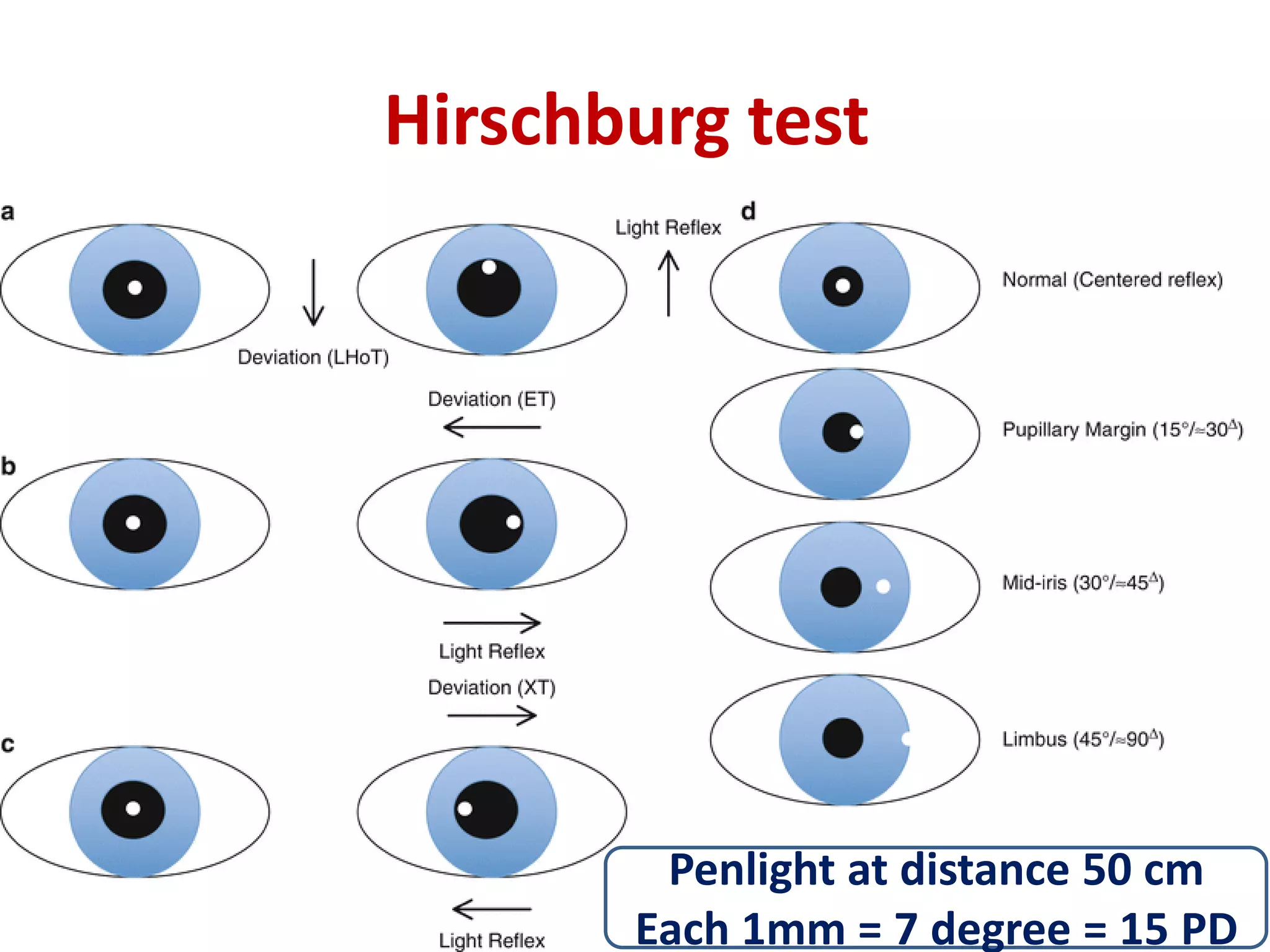 Hirschburg test
Penlight at distance 50 cm
Each 1mm = 7 degree = 15 PD
 