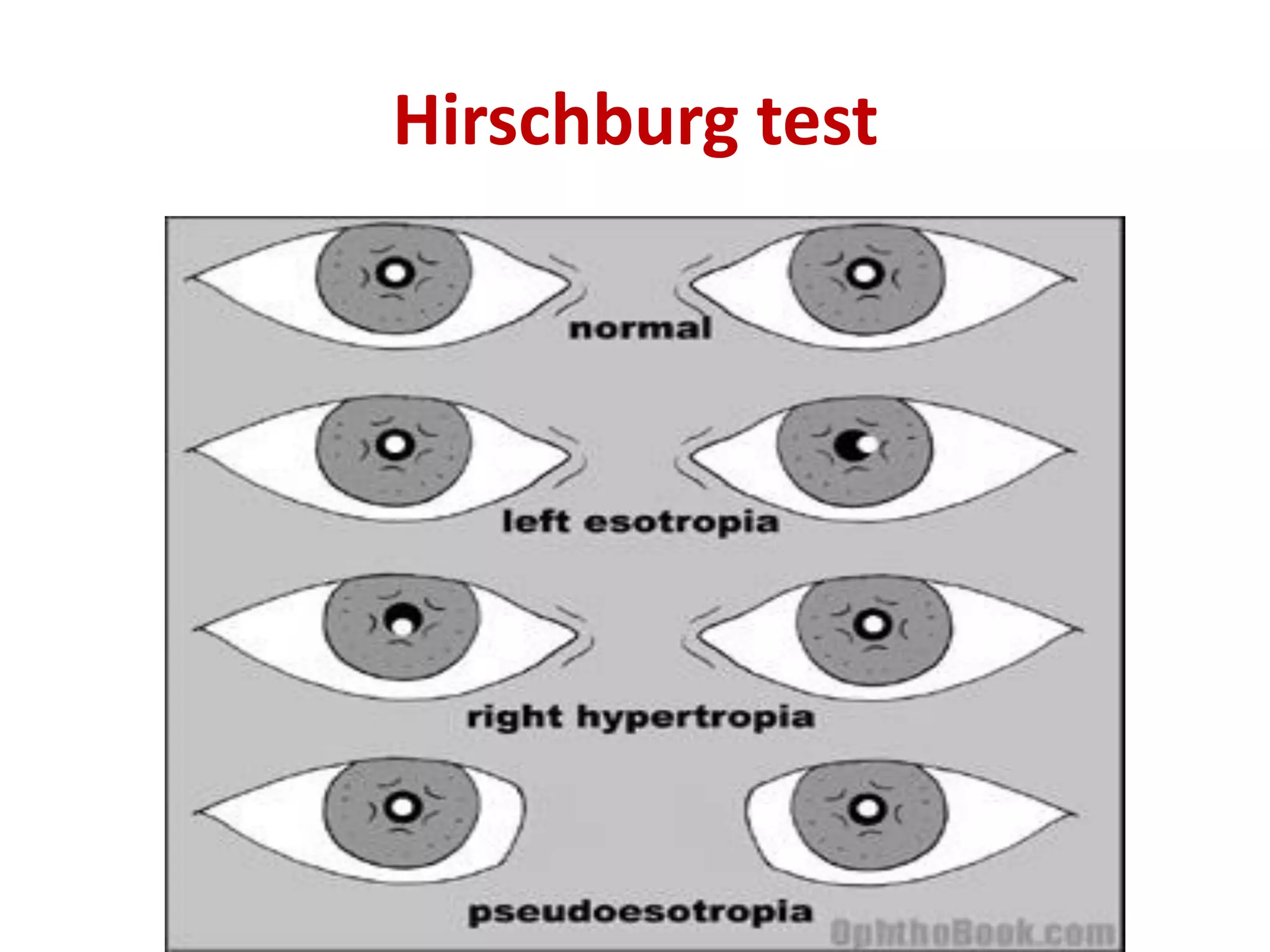 Hirschburg test
 