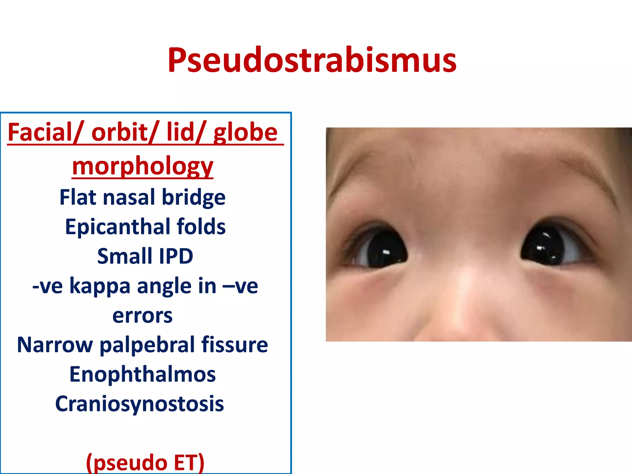 Pseudostrabismus
Facial/ orbit/ lid/ globe
morphology
Flat nasal bridge
Epicanthal folds
Small IPD
-ve kappa angle in –ve
errors
Narrow palpebral fissure
Enophthalmos
Craniosynostosis
(pseudo ET)
 