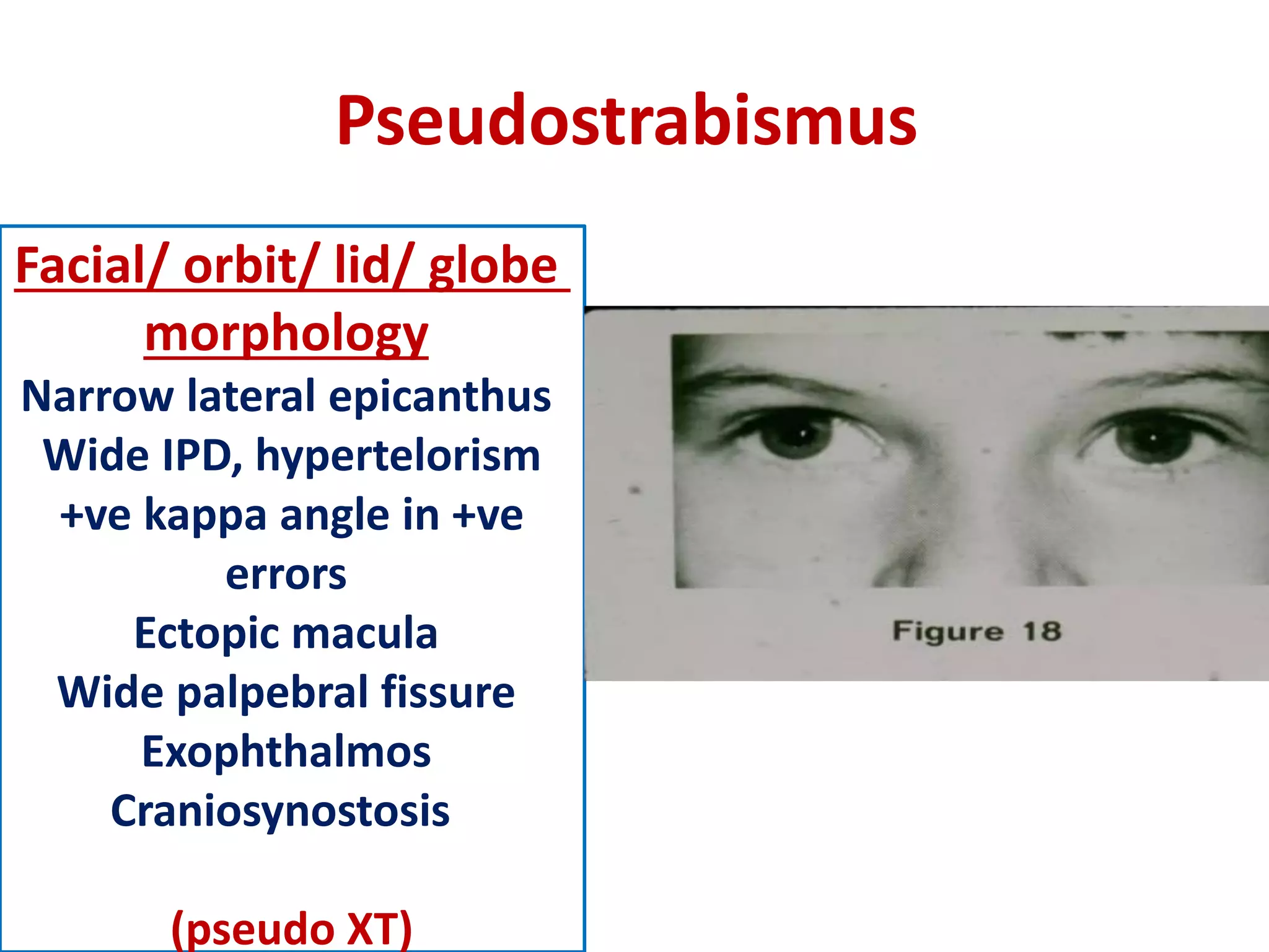 Pseudostrabismus
Facial/ orbit/ lid/ globe
morphology
Narrow lateral epicanthus
Wide IPD, hypertelorism
+ve kappa angle in +ve
errors
Ectopic macula
Wide palpebral fissure
Exophthalmos
Craniosynostosis
(pseudo XT)
 