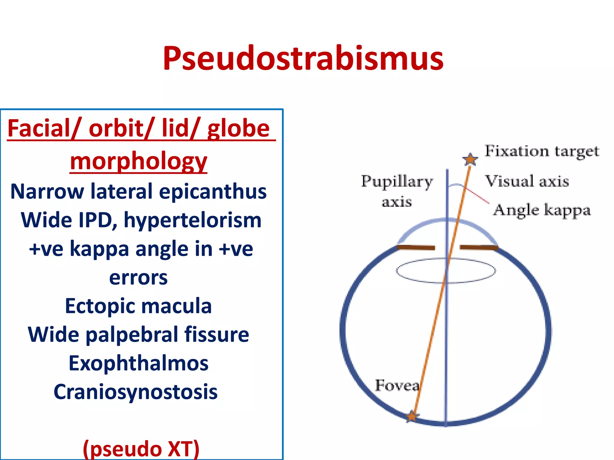 Pseudostrabismus
Facial/ orbit/ lid/ globe
morphology
Narrow lateral epicanthus
Wide IPD, hypertelorism
+ve kappa angle in +ve
errors
Ectopic macula
Wide palpebral fissure
Exophthalmos
Craniosynostosis
(pseudo XT)
 
