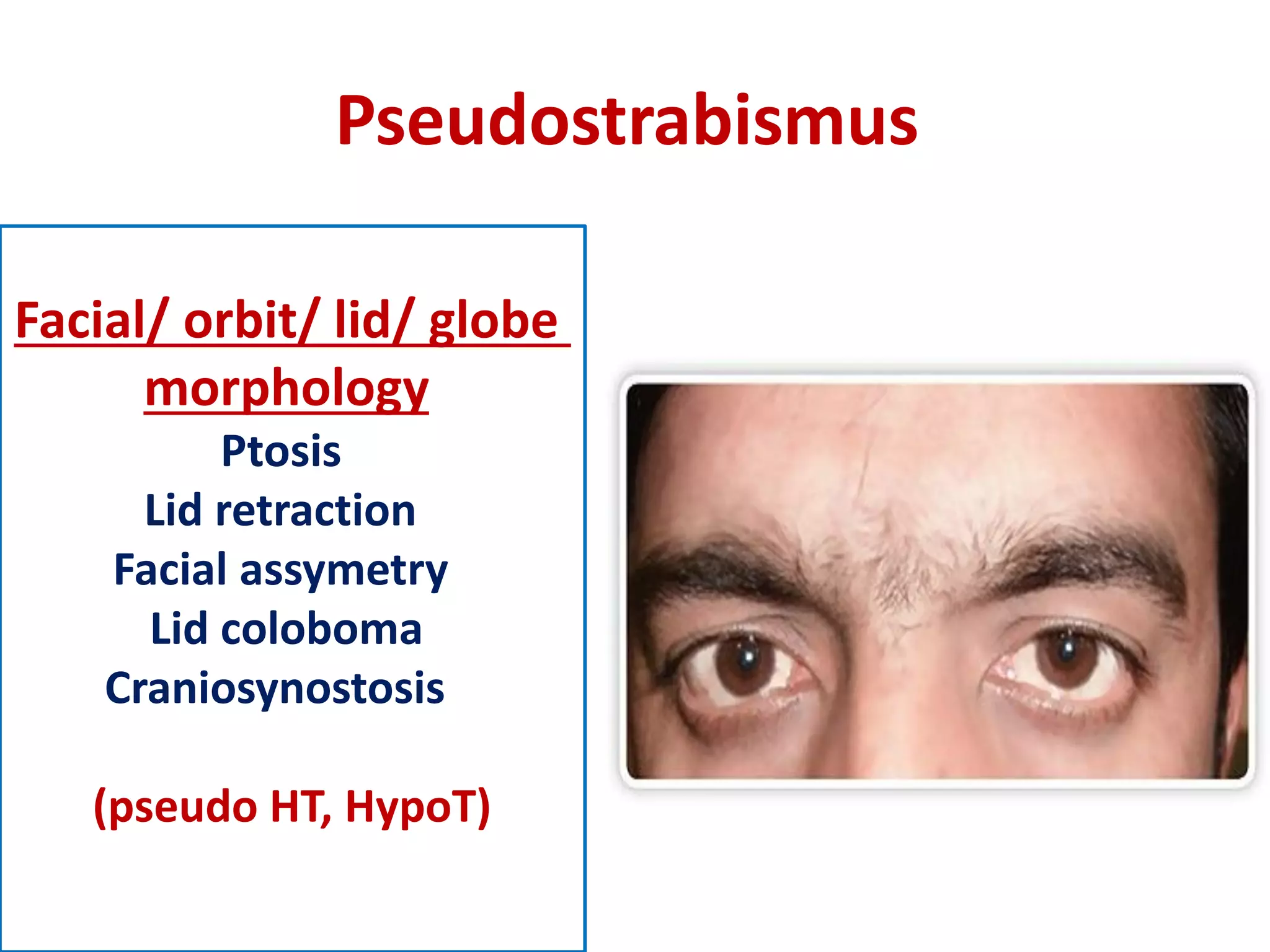 Pseudostrabismus
Facial/ orbit/ lid/ globe
morphology
Ptosis
Lid retraction
Facial assymetry
Lid coloboma
Craniosynostosis
(pseudo HT, HypoT)
 