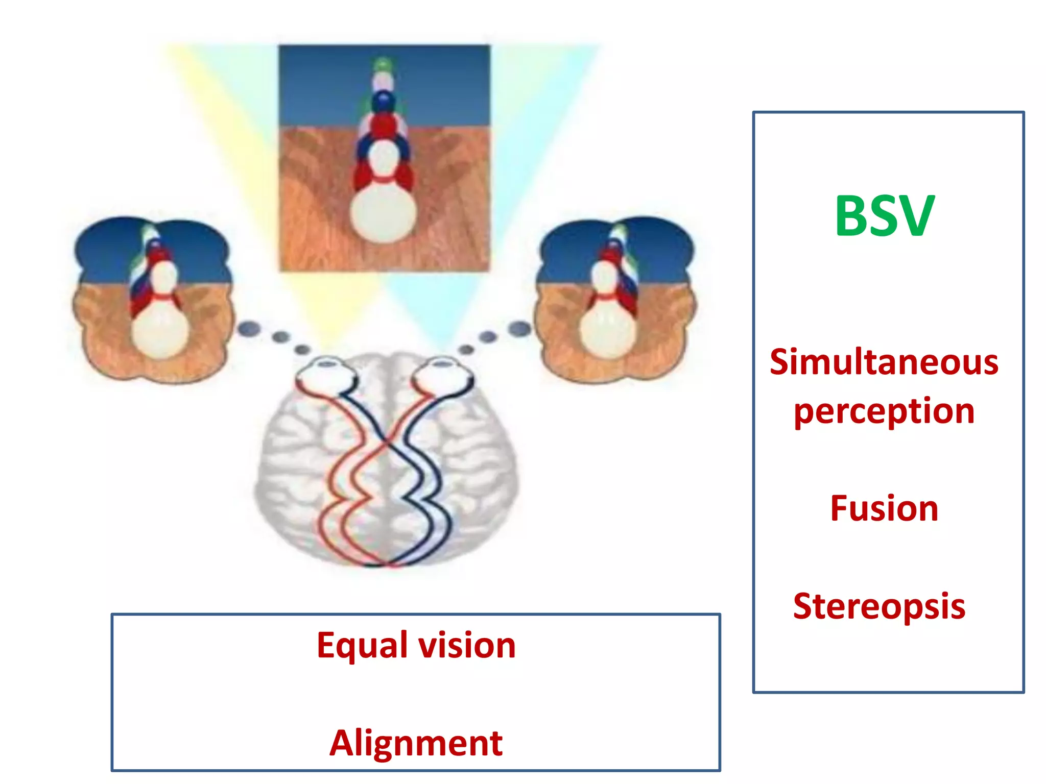 BSV
Simultaneous
perception
Fusion
Stereopsis
Equal vision
Alignment
 